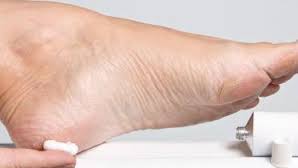 ترک پا یکی از مشکلات رایج در کف پای افراد