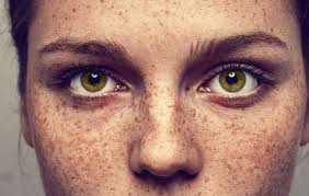 خلاصی از کک و مک با روش های مخصوص به اینکار خلاصی از کک و مک با روش های مخصوص به اینکار